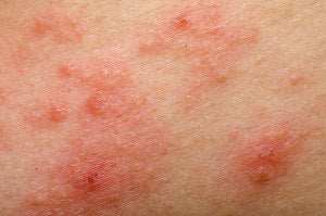All Time Best For Itching Treatment