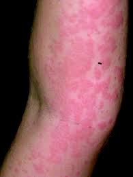 All Time Best For Itching Treatment