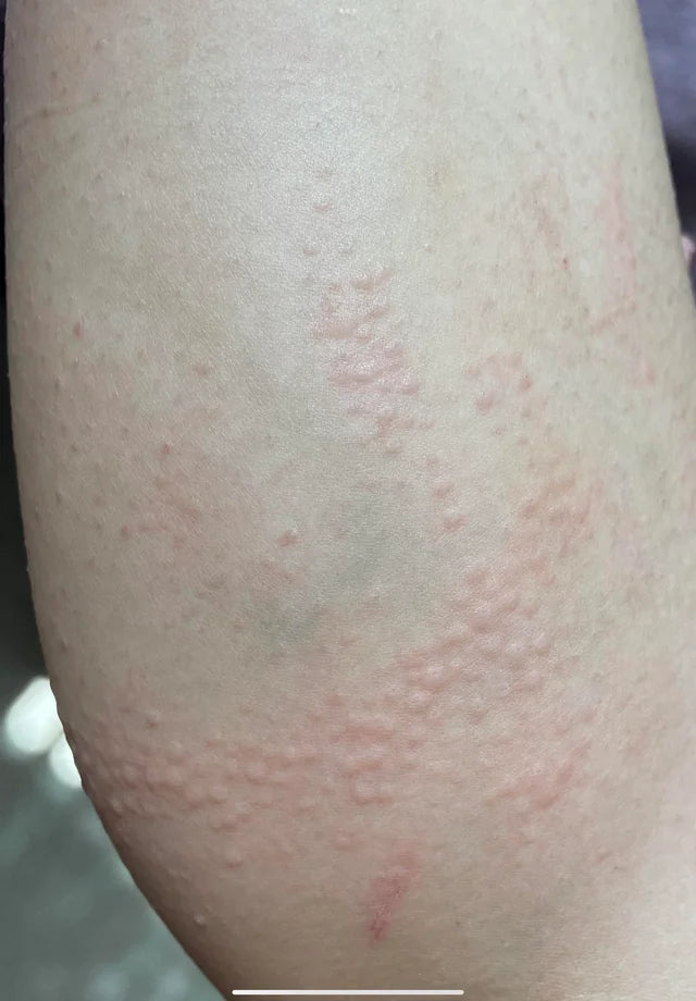 All Time Best For Itching Treatment